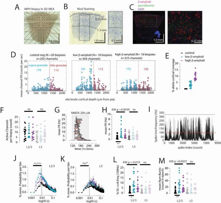 Read more about the article NEURONS FIRE IN EARLY ALZHEIMER’S LINKING ELECTROPHYSIOLOGY TO MICROGLIAL STATES